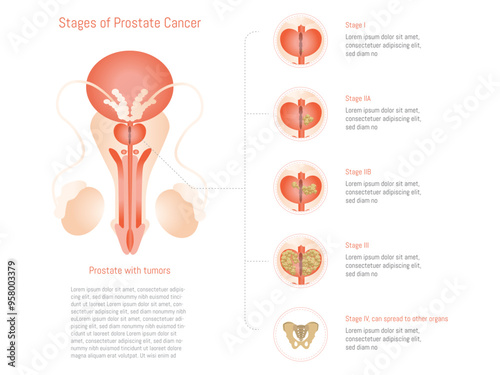 0711_cancerDetailed illustration depicting the different stages of prostate cancer, from early to advanced stages. The image includes a representation of the prostate with tumors in var_prostata_eltos