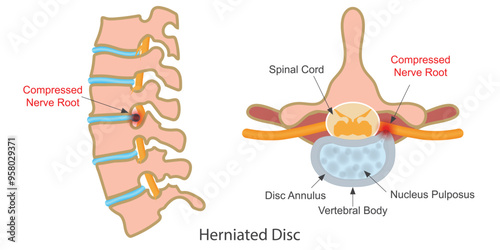 Herniated disk is a condition that can occur anywhere.