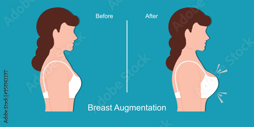 Breast augmentation is a common type of cosmetic surgery.