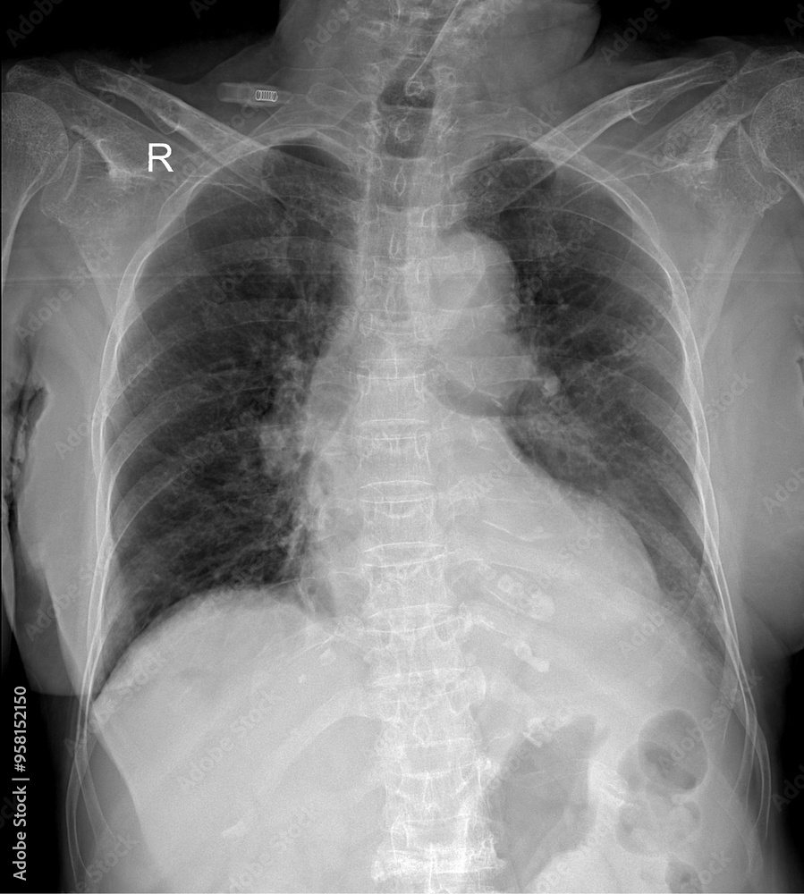 X-Ray Imaging of the Thoracic Cavity: Diagnosing Lung and Heart Issues X-Ray Imaging of the Thoracic Cavity: Diagnosing Lung and Heart Issues