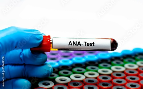 Tableau sur toile Blood sample tube for anti-nuclear antibody (ANA) test analysis.