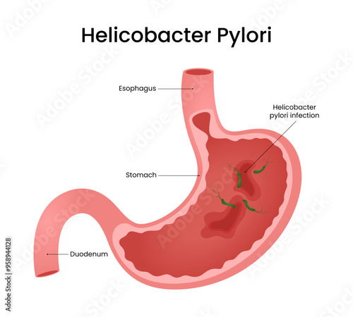 Causes of Helicobacter Pylori Infection