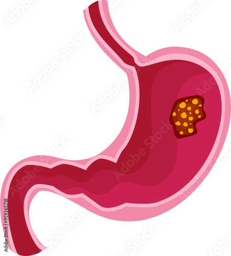 Stomach disease Illustration. Stomach cancer