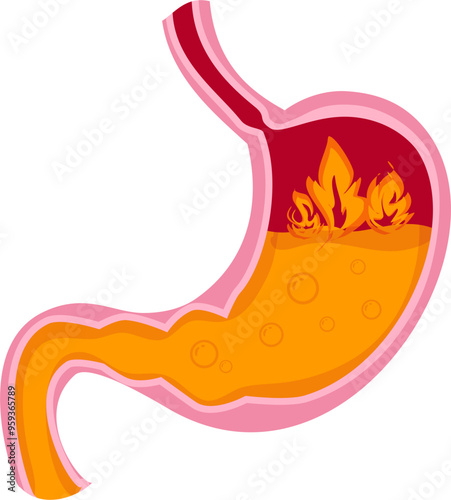 Stomach disease Illustration. Heartburn 