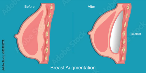 Breast augmentation is done by placing implants.