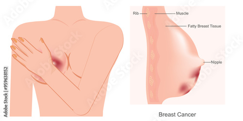 Breast cancer is when breast cells mutate.