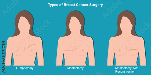Types of Breast Cancer Surgery.