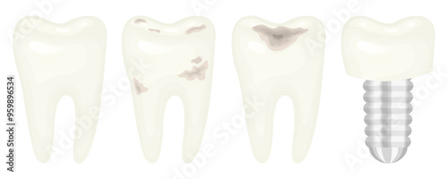 Naturalistic images of teeth in different conditions. White, healthy tooth with roots, teeth with caries and damage, dental implant. Molar, oral hygiene. Vector illustration for dentists.