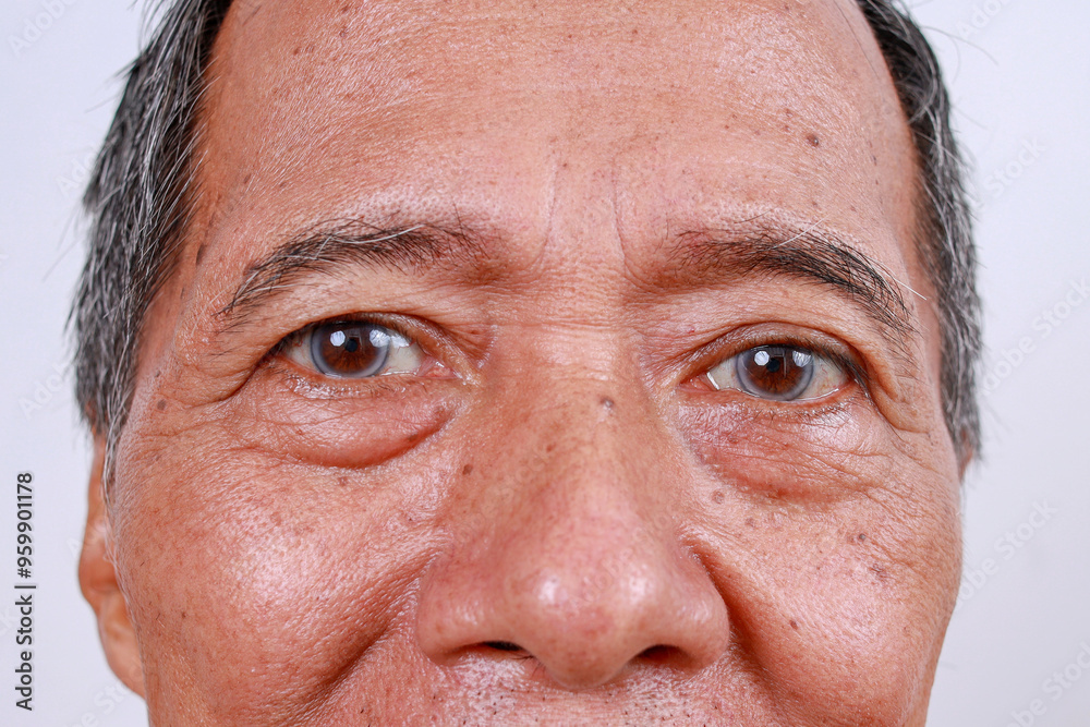 Obraz premium Close Up Of An Elderly Asian Man With Black Eye