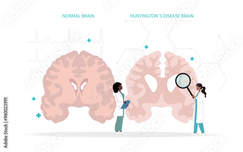 Medical illustration comparing a normal brain with one affected by Huntington's disease. Two researchers analyze the structural differences, highlighting the deterioration associated with this neurode photo