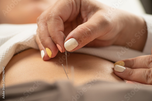 Acupunturist stimulating stomach acupunture points to treat edema photo