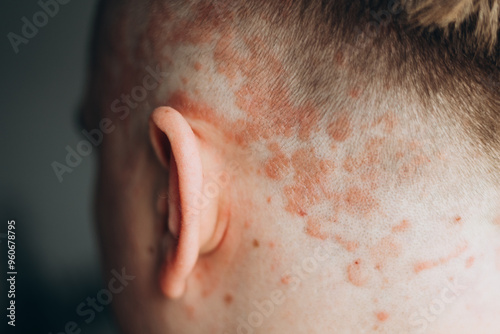 Obraz na płótnie Psoriasis on the skin close-up, scalp, photos of dermatitis and eczema, skin problems concept, dermatology banner w salonie