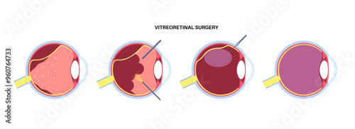 Vitreoretinal surgery poster