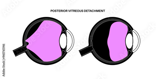 Posterior vitreous detachment