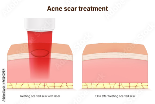 Acne scar and laser treatment. Skin repair. Steps of during and after laser scar treatment.