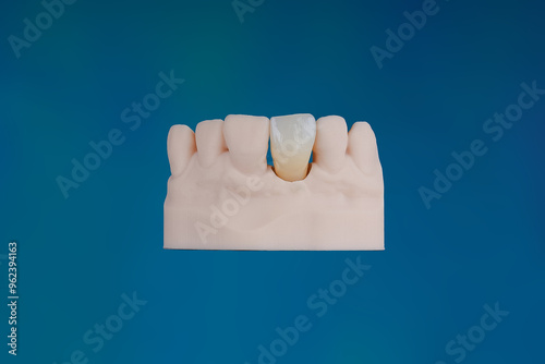 Mirror copy of central maxillary incisor, ultra thin dental ceramic veneer or crown on printed model photo