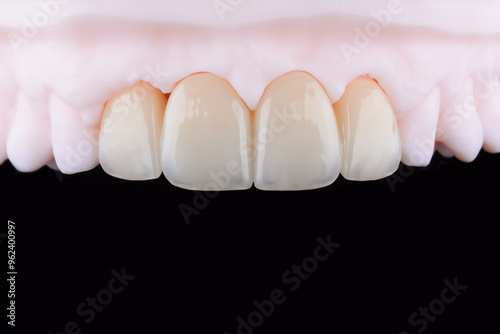 High-quality naturally dental single crowns made of zirconia and stained like old man teeth. photo