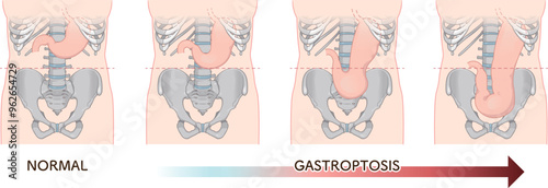 胃下垂、胃、胃アトニー、STAGE OF GASTROPTOSIS photo