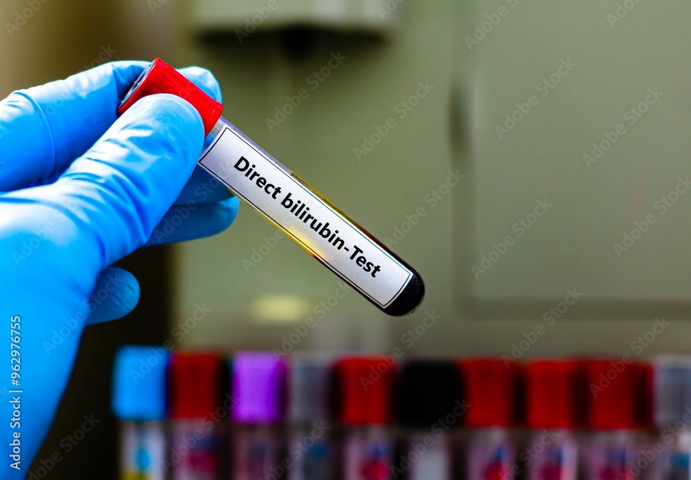 Fototapeta premium Blood sample tube for direct bilirubin test analysis.