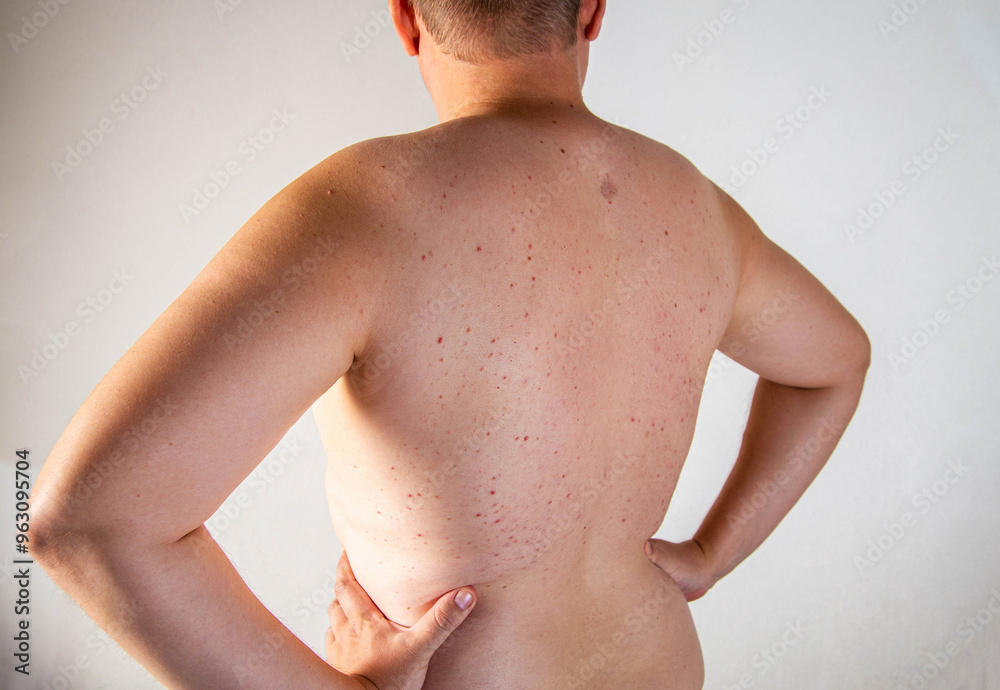 A man has a scar and red pimples on his skin due to poor hygiene. Inflammation of the sebaceous glands, close-up A man has a scar and red pimples on his skin due to poor hygiene. Inflammation of the sebaceous glands, close-up