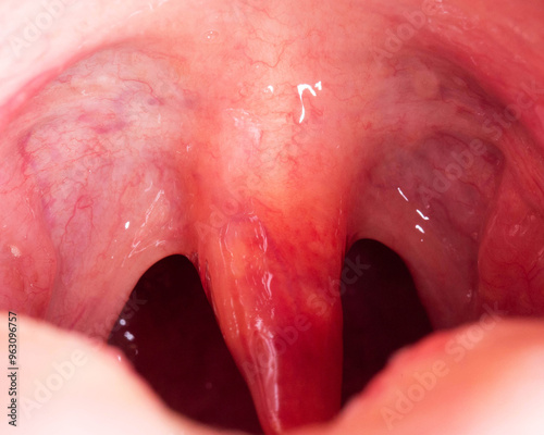 Red, inflamed and swollen uvula in the throat. Treatment of uvulitis due to bacteria and streptococcal viruses. Otolaryngology, macro photo