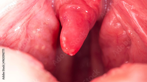 Red, inflamed and swollen uvula in the throat. Treatment of uvulitis due to bacteria and streptococcal viruses. Otolaryngology, macro photo