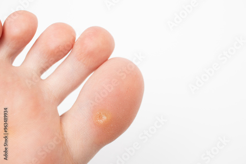 Wart on the big toe foot. HPV virus