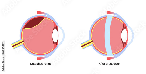 Scleral buckle procedure photo