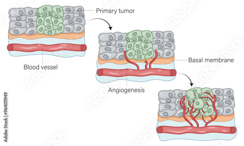 How Cancer Cells Create New Blood Vessels: The Angiogenic Process