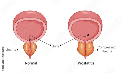 Detailed Pathology of Prostatitis Compared with Normal Prostate: Comprehensive Illustration Highlighting Inflammation, Structural Changes, and Symptoms for Medical Education