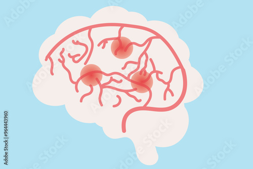 A transient ischemic attack (TIA) is a brief interruption of blood flow to the brain, causing stroke-like symptoms.  Related diseases: stroke, atherosclerosis, hypertension.pain