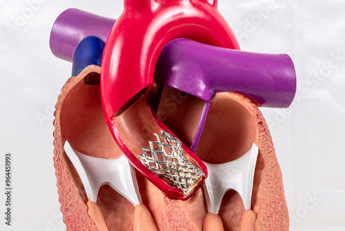 Cardiac model of Transcatheter aortic valve implantation (TAVI) for people education. Heart transplant and surgery concept, shunting. Plastic human heart model showing the interior.