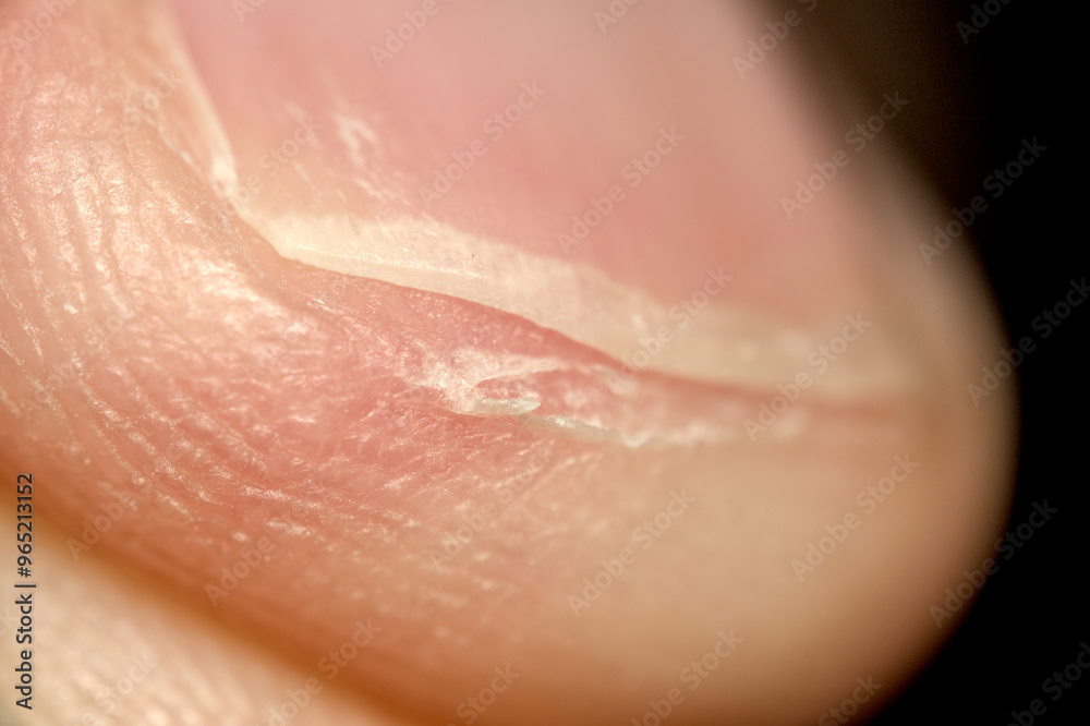 Fototapeta premium Close up of peeling finger