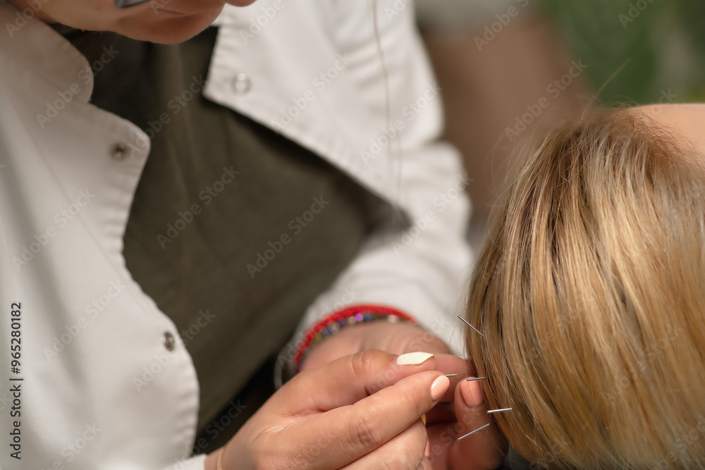 Obraz premium Neuroacupuncture treatment for headaches and other chronic pain