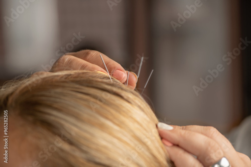 Scalp acupuncture therapy photo