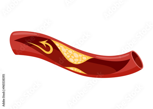 Atherosclerosis stage. Anatomy of heart attack. Arteriosclerotic vascular disease or ASVD. Atherosclerotic plaque in coronary artery. Vector illustration on white background