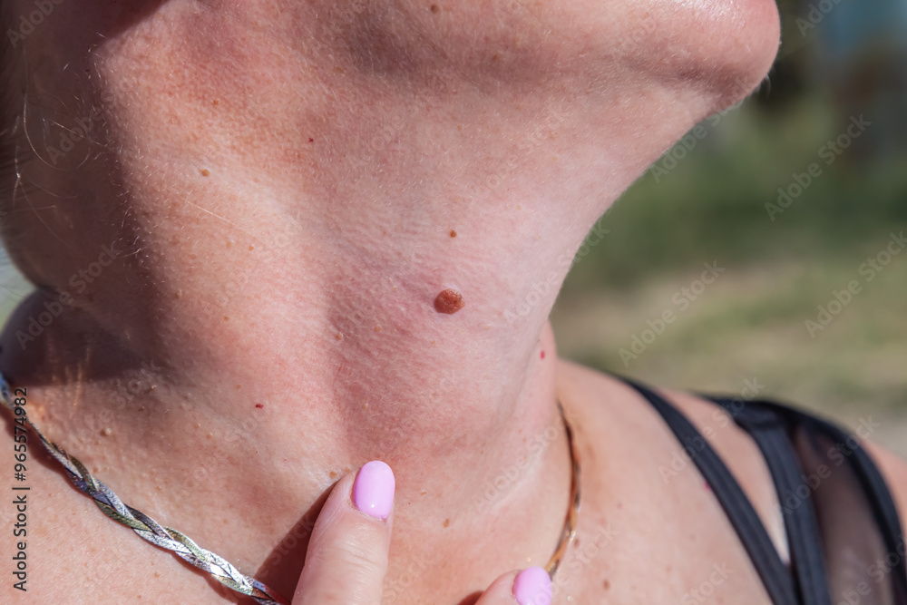 Woman examing her abnormal mole. Dermatology procedure. Doctor checking patient skin cancer melanoma. Dark wart at female neck. Removal papilloma treatment Woman examing her abnormal mole. Dermatology procedure. Doctor checking patient skin cancer melanoma. Dark wart at female neck. Removal papilloma treatment