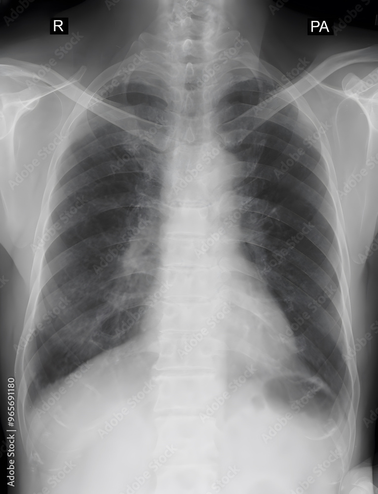 CXR (PA) view of chest infection and minimal (Rt) pleural effusion CXR (PA) view of chest infection and minimal (Rt) pleural effusion