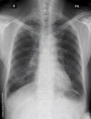 CXR (PA) view of chest infection and minimal (Rt) pleural effusion  photo