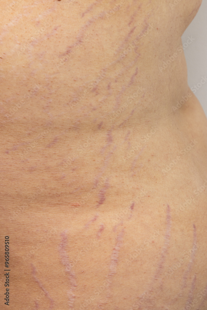 Fototapeta premium A woman's back has a scar that is purple and red