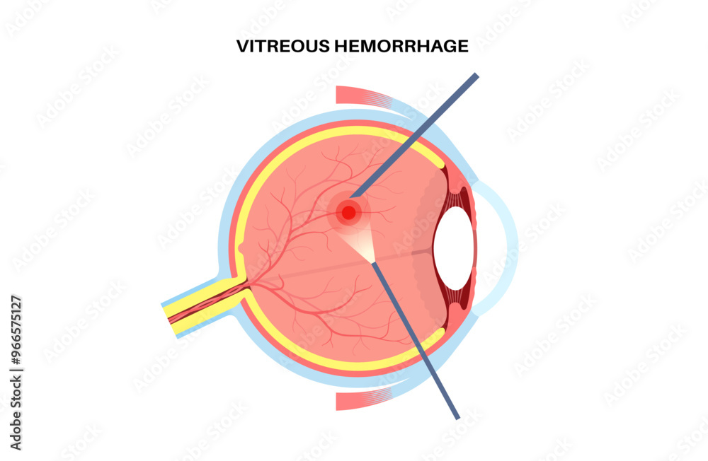 Vitreous hemorrhage poster Vitreous hemorrhage poster