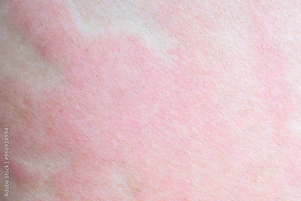 Skin allergy rash dermatitis texture close up