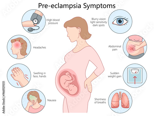 key symptoms of pre-eclampsia in pregnant women, high blood pressure, headaches, nausea, and swelling diagram hand drawn schematic vector illustration. Medical science educational illustration