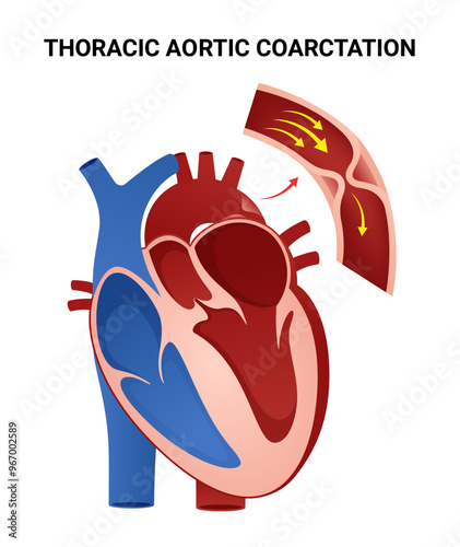 Coarctation of the Aorta Causes