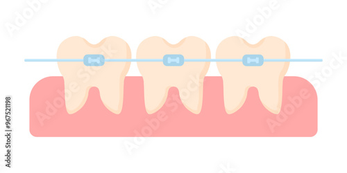 Braces are installed on the teeth in cartoon style on a white isolated background. Braces on healthy teeth. Dental treatment. Malocclusion