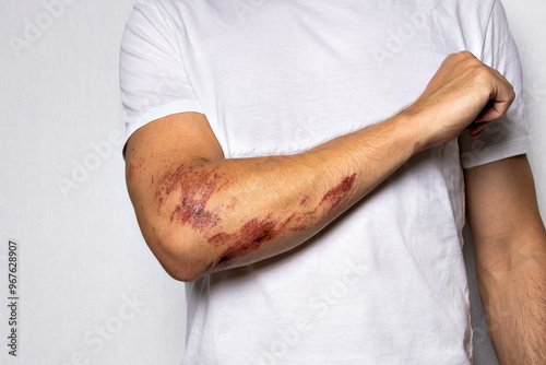 Arm with a Large Abrasion Wound