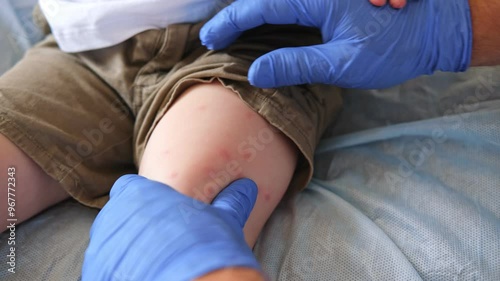 Doctor examining child with bodily red rash. Kid allergy closeup. Little baby scratches an eruption. Nurse applies special cream to atopic skin. Dermatitis, irritation, hive. Pruritus. Mosquito bites photo