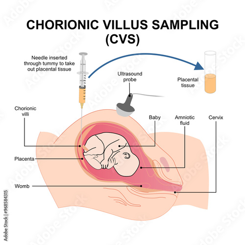 Chronic Villus Sampling (CVS) medical illustration