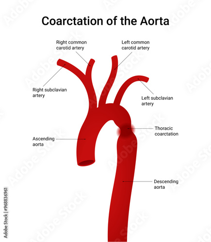 Schematic Diagram of Aortic Coarctation
