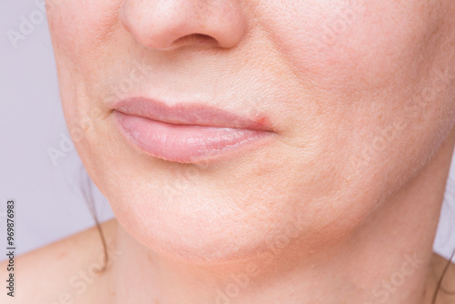 Antiviral drugs for herpes infection of the lips and mouth area. Close-up of a woman's face with swelling on her lips.